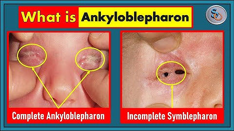 Ankyloblepharon- Definition, Types, Causes & Treatment