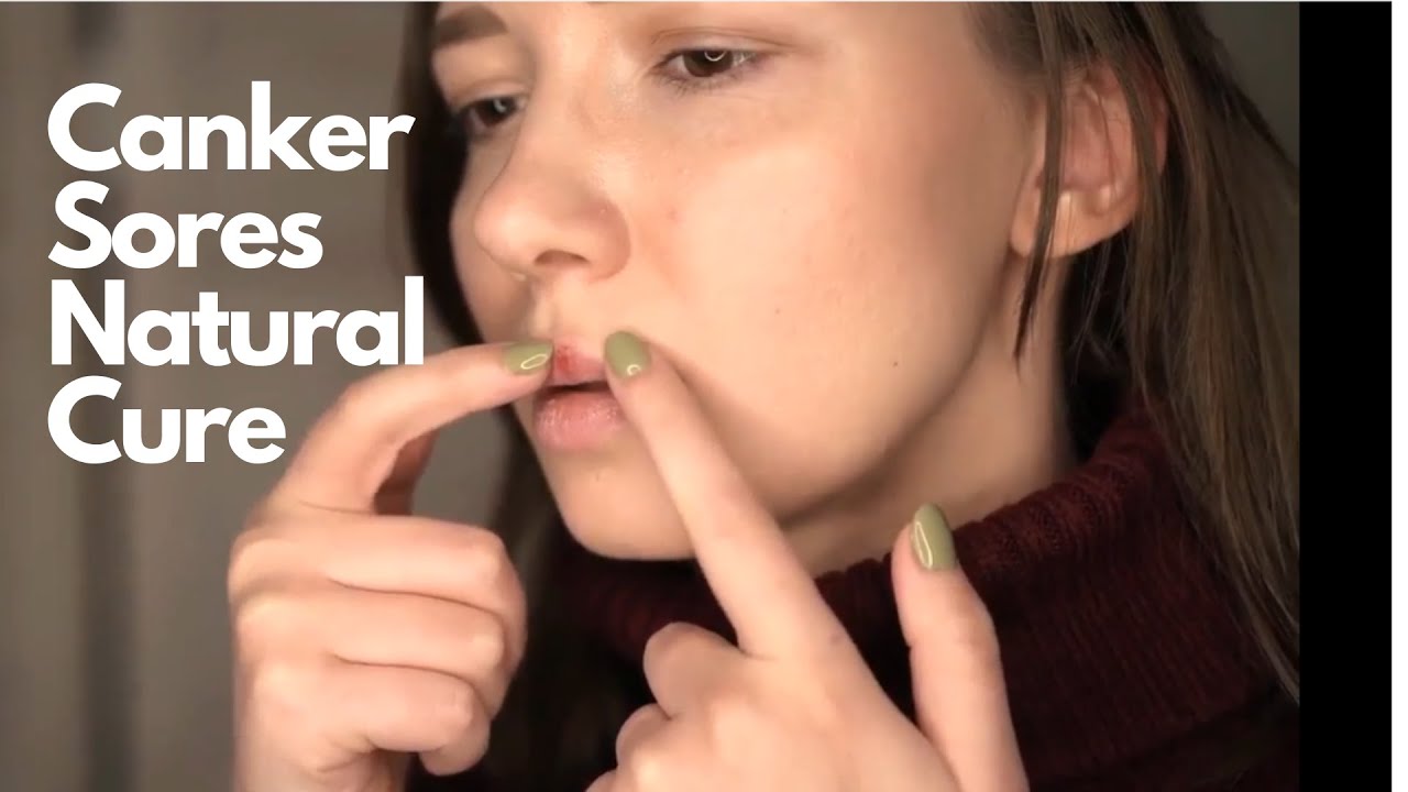 Honey for canker sores