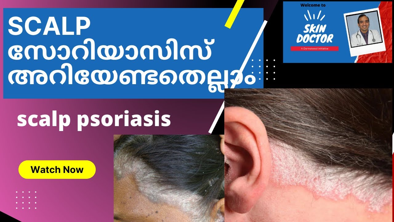 SCALP ‌സോറിയാസിസ്  അറിയേണ്ടതെല്ലാം /scalp psoriasis talk by dermatologist Dr.Sujith Kumar/psoriasis