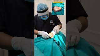 Knife Injury Scar Treatment | Advanced Scar Revision Procedure #scarrevision #facialscar #skincare