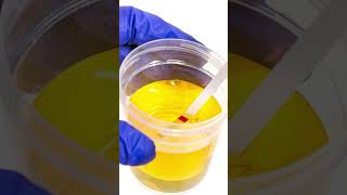 Blood in Urine: Causes, Risks & When to See Doctor