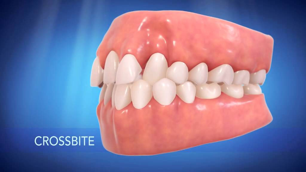 Invisalign General Information - PearlFection Dentistry