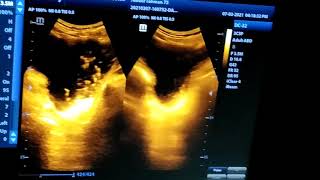 Echoes In Urinary Bladder, Diagnosis?