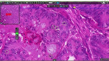 3DHISTECH - Marker counter & Tracking history in CaseViewer
