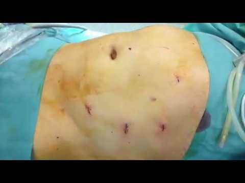 Plastica Laparoscopica di doppia Ernia Addominale / Laparoscopic Repair of a double Ventral Hernia