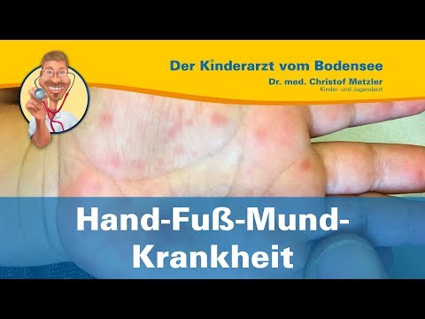 Video: Sieht die Hand-Fuß-Mund-Krankheit aus wie Insektenstiche?