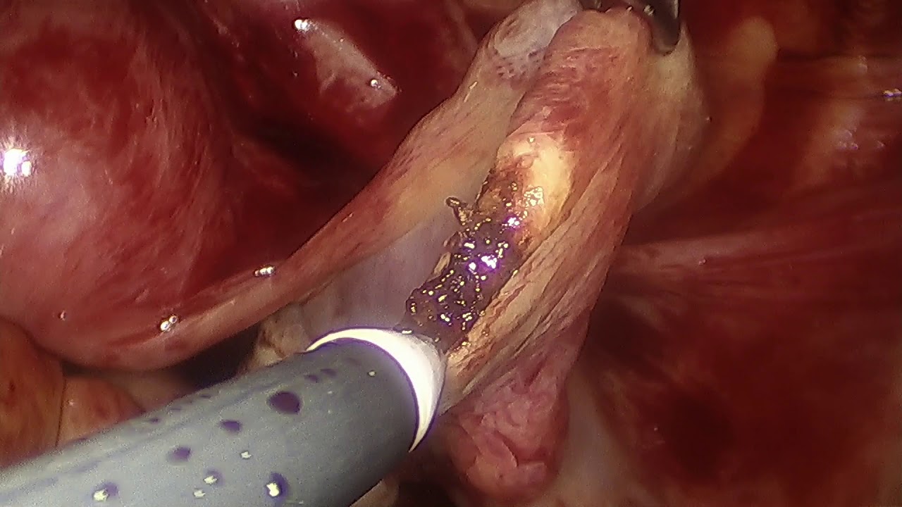 Laparoscopic salpingostomy for ectopic pregnancy