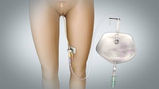 Removal of Foley Catheter (Female)