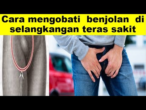Cara mengobati benjolan di selangkangan teras sakit 