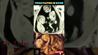 Twins playing in the womb ? ?   Baby movement in the womb - Baby kicks shortsvideo pregnancy baby