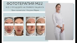 Фототерапия М22 - Всё о процедуре с примерами работ