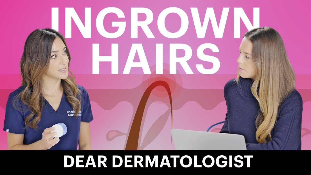 How does a dermatologist treat ingrown hairs? YouTube
