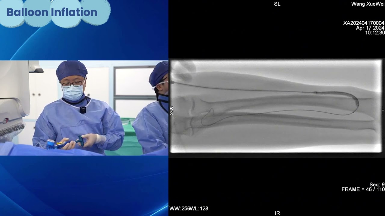 Tri-Wedge Operation Instruction Video