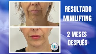 RESULTADO MINILIFTING