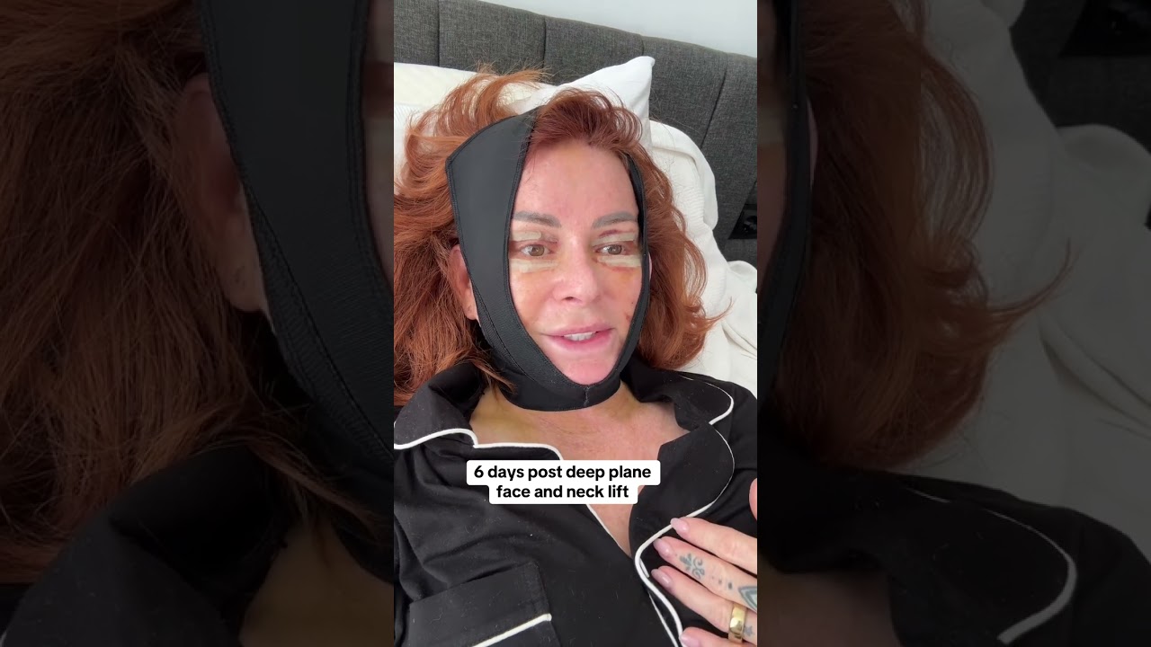 Facelift recovery journey. 6 days post op