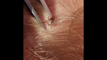 Removing a tic from a toddler