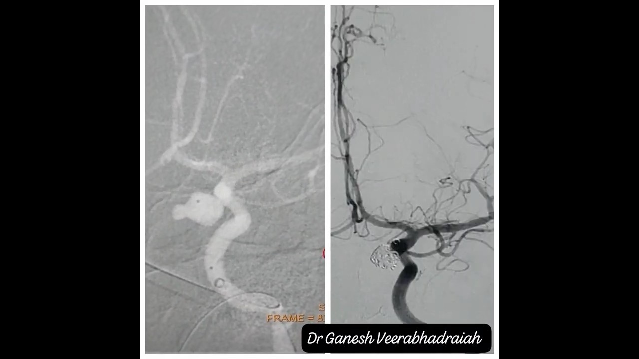 Endovascular Surgery-Coiling of Aneurysm-First coil and Complete Coiling.