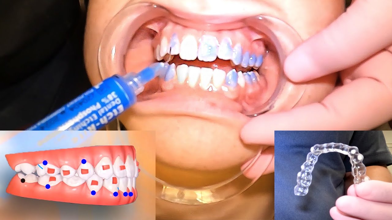 Invisalign Braces Fitting Appointment - Step by Step Breakdown! McKinney Orthodontist