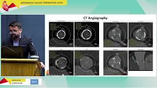 I. Kosmas, I. Iakovou | Case LIVE-in-a BOX: ViV case with Coronary Protection | Onassis Hospital