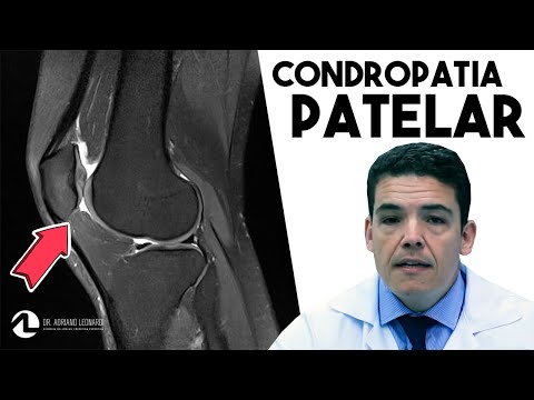 Vídeo: A Forma óssea Medeia A Relação Entre Sexo E Osteoartrite Incidente No Joelho