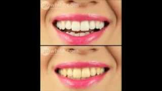 Klinik Du Piercing - Blanchiment Des Dents