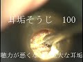 耳垢そうじ/聞こえが悪くなった巨大な耳垢/100