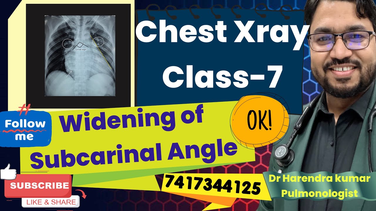 Is it difficult to identify widening of subcarinal angle on xray 