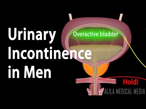Urinary Incontinence in Men, Animation