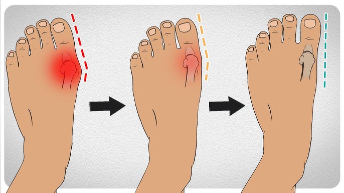 Bunion Rehab - How to Stretch and Mobilize Your Big Toe 