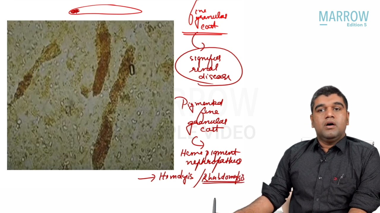 Medicine : Urinary Casts - Marrow Edition 5 (Clinical Core) Sample Video