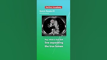 Aortic Dissection on CT Explained #radiology