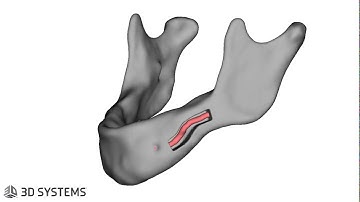 IAN Lateralization/Transposition Osteotomy VSP by 3D Systems