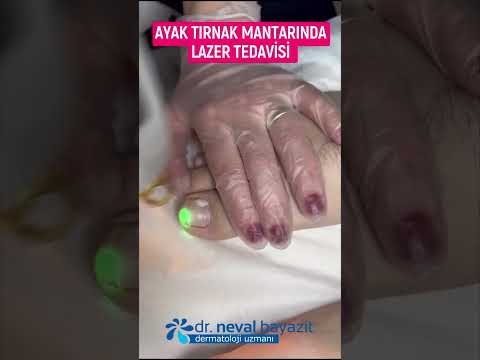 AYAK TIRNAK MANTARINDA LAZER TEDAVİSİ