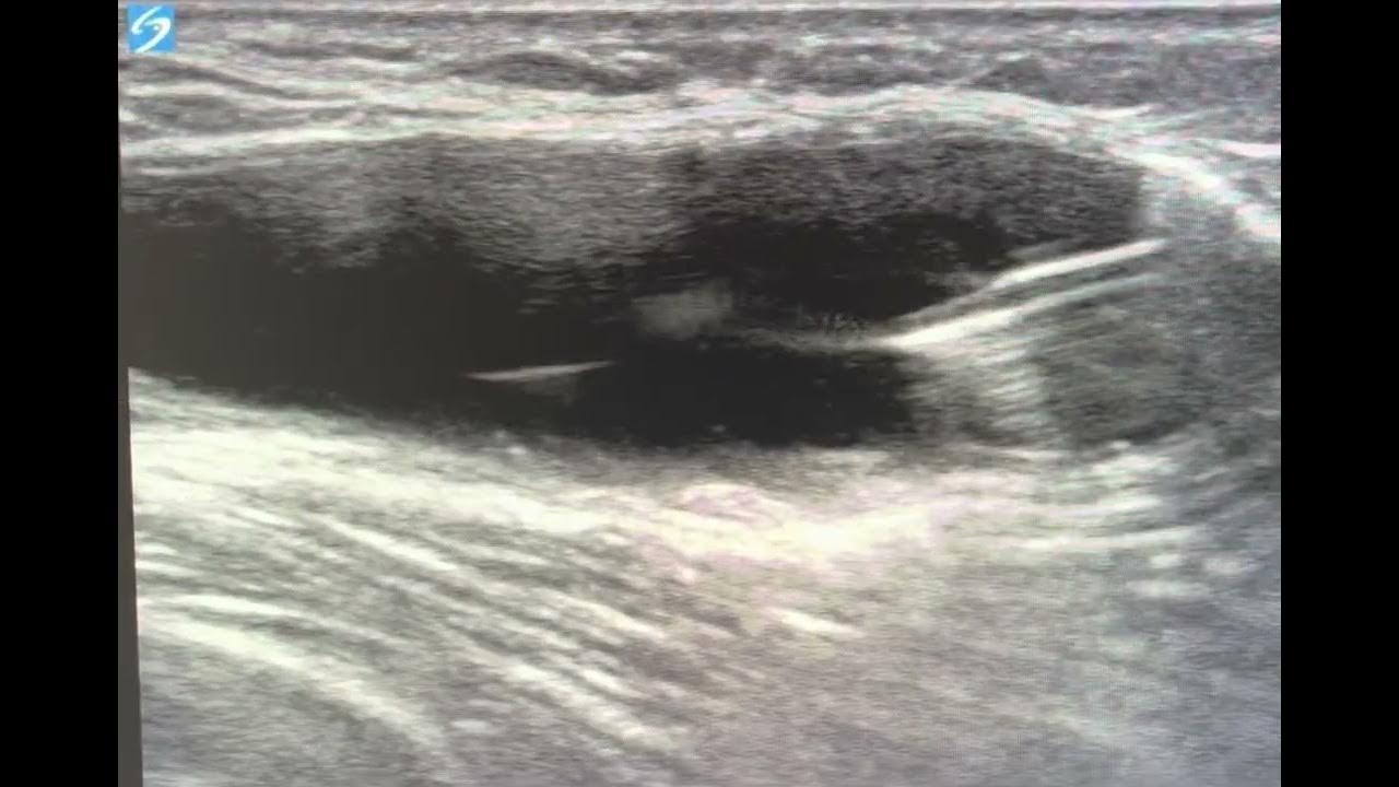ultrasound guided baker's cyst aspiration YouTube
