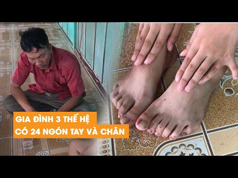 Video Gia đình ĐẶC BIỆT 3 thế hệ có 24 ngón tay chân ở miền... - youtube