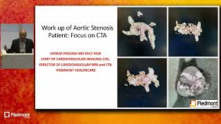 Work Up of Aortic Stenosis Patient: Focus On CTA