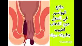 علاج البواسير/طريقة علاج البواسير في المنزل /وصفه سهله لعلاج البواسير في المنزل