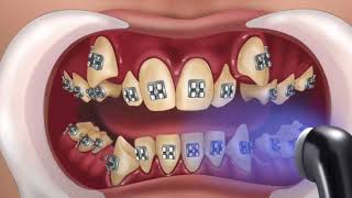 INCREIBLE reconstrucción de diente dañado por caries: Endodoncia en 4K