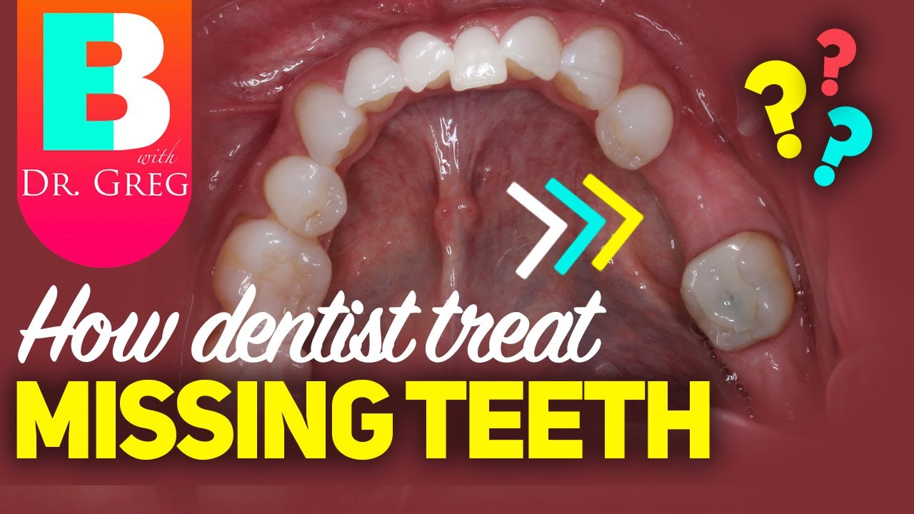 Dental Implants Vs Bridges For Missing Teeth
