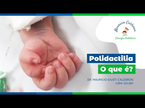 Vídeo: Polidactilia: 6 Sintomas, Causas, Tratamento E Muito Mais