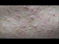 Acne Treament Under The Skin #038