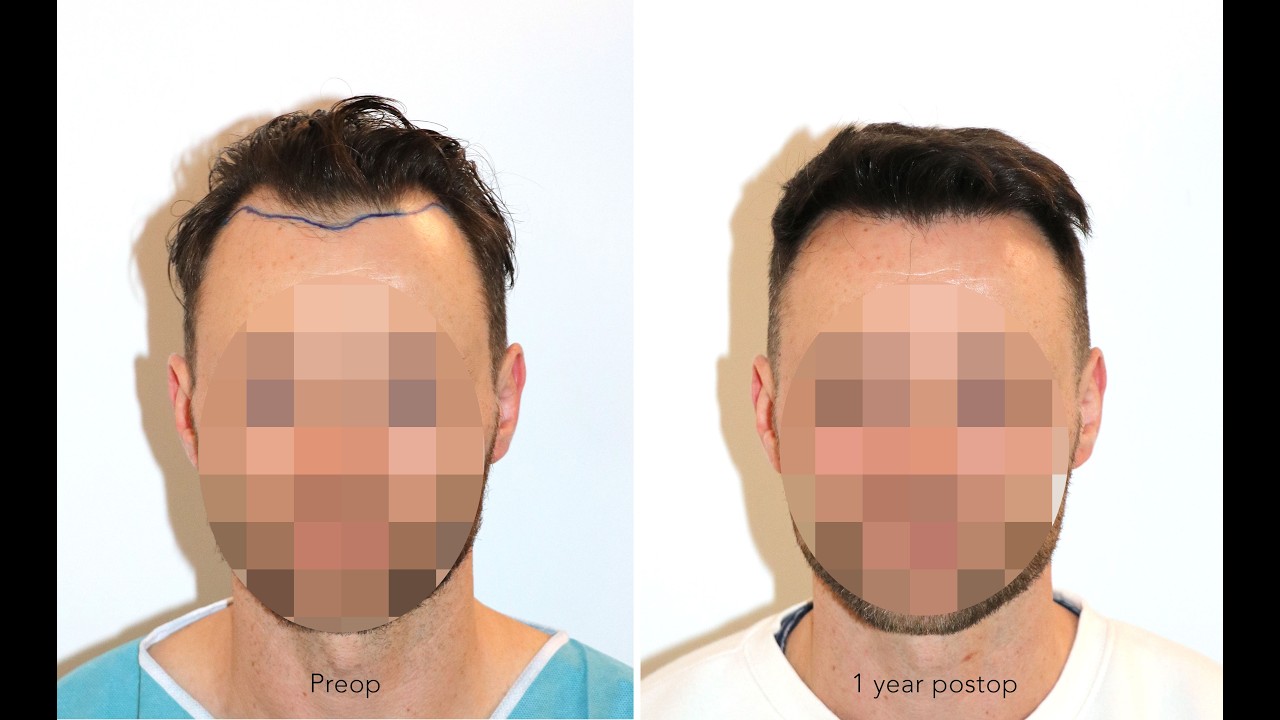 Hair Transplant Receding Hairline | Before After | 2285 FUs | FUE | Dr. Feriduni