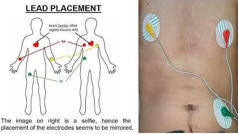 IoT-Based Remote Patient Monitoring System to Measure Vital Body Signs