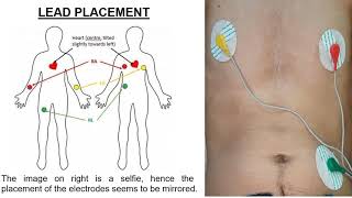 IoT-Based Remote Patient Monitoring System to Measure Vital Body Signs