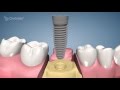 Dental implant procedure  one stage