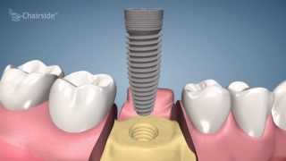 Dental Implant Procedure  One Stage