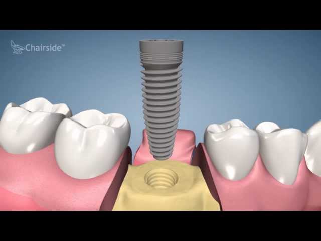 Dental Implant Procedure - One Stage class=