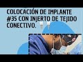 Colocación de implante dental  con tejido conectivo. CIRUGÍA ORAL- IMPLANTE DENTAL. Dr. Anzony Reyes