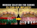 Modern Solution for Saving 23-Year-Old Implants