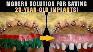 Modern Solution for Saving 23-Year-Old Implants